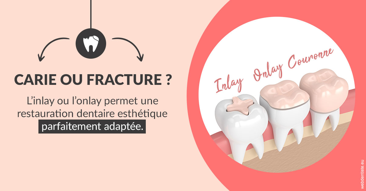 https://dr-lenouvel-isabelle.chirurgiens-dentistes.fr/T2 2023 - Carie ou fracture 2