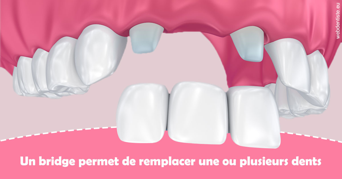 https://dr-lenouvel-isabelle.chirurgiens-dentistes.fr/Bridge remplacer dents 2