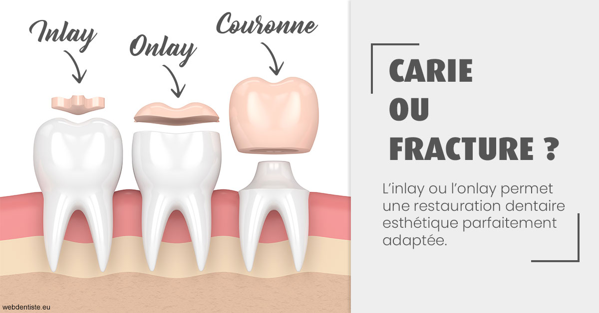 https://dr-lenouvel-isabelle.chirurgiens-dentistes.fr/T2 2023 - Carie ou fracture 1