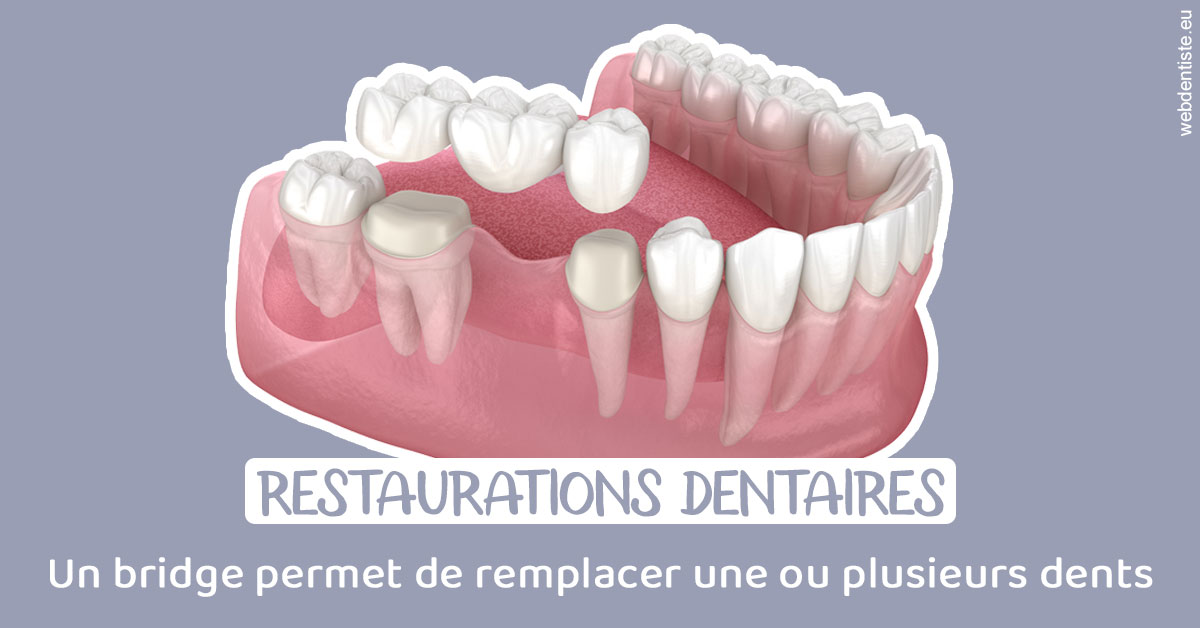 https://dr-lenouvel-isabelle.chirurgiens-dentistes.fr/Bridge remplacer dents 1