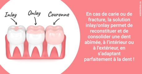 https://dr-lenouvel-isabelle.chirurgiens-dentistes.fr/L'INLAY ou l'ONLAY 2
