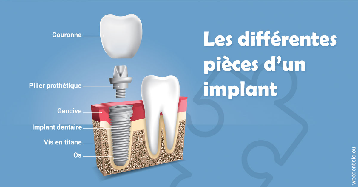 https://dr-lenouvel-isabelle.chirurgiens-dentistes.fr/Les différentes pièces d’un implant 1